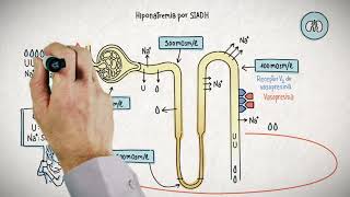 HIPONATREMIA Y SU TRATAMIENTO [upl. by Yanad201]