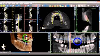 Blue Sky Plan 3 Tutorial Placing Implants [upl. by Tallie]