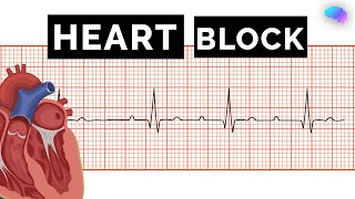 Heart Block  AV Block  ECG  EKG  OSCE Guide  UKMLA  CPSA [upl. by Aihsot639]