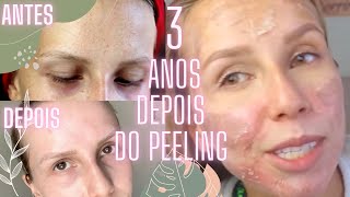 3 ANOS DEPOIS DO PEELING AS MANCHAS VOLTARAM  Bruna Harmel [upl. by Stefano93]