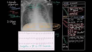 Insuffisance cardiaque aigue  Partie 2  Docteur Synapse [upl. by Ehtyaf]