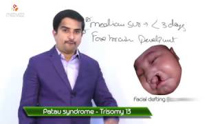 Patau syndrome  Trisomy 13  Usmle quick review [upl. by Brink]