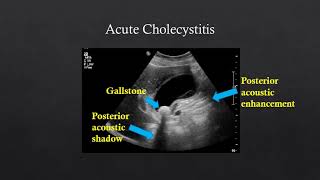 Abdominal US  GallstonesCholecystitis Renal StonesHydronephrosis [upl. by Dreyer]