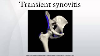 Transient synovitis [upl. by Atiugram973]