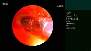 Complex Tracheal amp Bronchial Stenosis  Rigid Bronchoscopy  CRE balloon dilation  Cryoablation [upl. by Barny989]