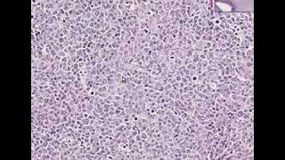 Histopathology Lymph node Diffuse large Bcell lymphoma [upl. by Monty]