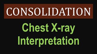 Lung Consolidation  Chest Xray Interpretation [upl. by Inigo]