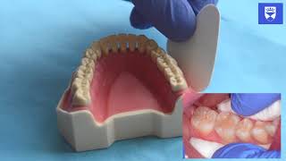 Technique for placing a resin fissure sealant [upl. by Esidnac]