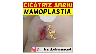 CICATRIZ DA MAMOPLASTIA ABRIU O QUE FAZER  Dr Ricardo Drummond [upl. by Ressan]