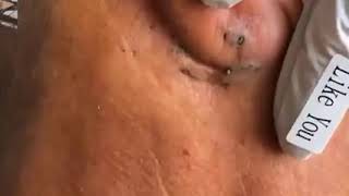 👌Satisfying acne removal  Traitement de lacné et points noirs en dessous de loreille [upl. by Donata]