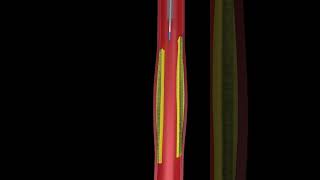 Animated angioplasty Explained in 3D  Watch the Procedure [upl. by Bekki213]