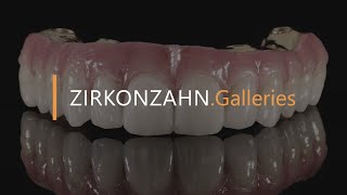 Prettau® 4 Anterior® zirconia on Sintermetall  ZirkonzahnGalleries [upl. by Eveineg]