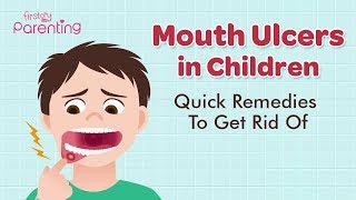 Mouth Ulcers Canker Sores in Children  Causes Symptoms amp Treatment [upl. by Baynebridge]