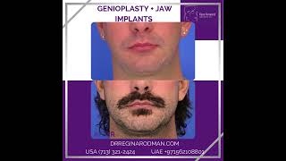 Genioplasty  Jaw Implants [upl. by Anitram]