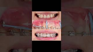 Gummy smile treatment by 4 mini implants and braces [upl. by Annirtak43]