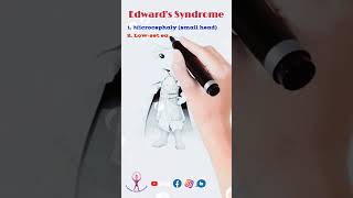 Mnemonic Edwards Syndrome neet fmge usmle biology [upl. by Dibrin947]