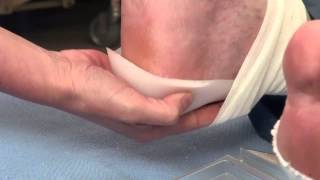 Pressure Ulcer Prevention ADERMA◊ Dermal Pad Heel Application [upl. by Tarabar444]