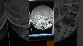 mastoid process xray radiography [upl. by Adnileb375]