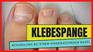 EINGEWACHSENEN NAGEL mit einer KLEBESPANGE behandeln  Podostripe Klebespange [upl. by Rosdniw272]