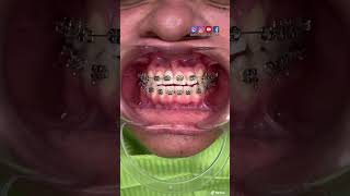 ¡🔥Frenillos metálicos con dientes FALSOS🔥 [upl. by Bihas]