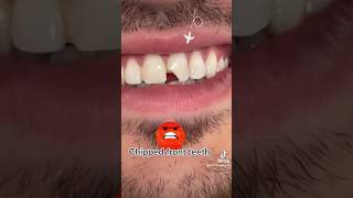 Chipped front tooth [upl. by Marietta]