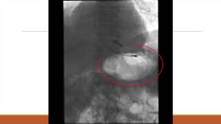 MSC Percutaneous Gastrostomy Tube Placement [upl. by Carlick]