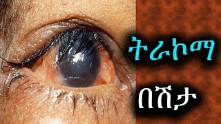 Trachoma trachomatis causes pictures disease prevention meaning 2019 in Ethiopia [upl. by Anitan388]