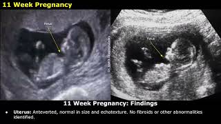 Obstetric Ultrasound Reporting  How To Write USG Reports  Pregnancy Sonography  TIFFA Scan [upl. by Zahc109]