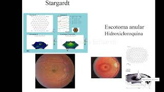 ERG multifocal y por pattern [upl. by Ayikan]