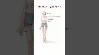 Marfan Syndrome kattrucate medicalreels marfansyndrome kyphosis scoliosis tall stature [upl. by Yenahc479]