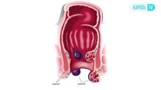 Basur Hemoroid Nedir Neden Olur [upl. by Einavoj]