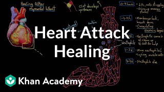 Healing after a heart attack myocardial infarction  NCLEXRN  Khan Academy [upl. by Edelman419]