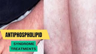 Antiphospholipid Syndrome Treatments [upl. by Fassold]