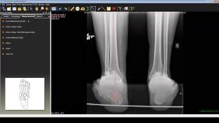 Foot and Ankle Deformity Correction with Dr Noman Siddiqui  Hindfoot Varus Deformity [upl. by Bussy]