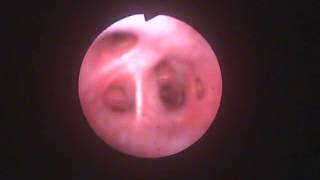 Veterinary Bronchoscopy536 Forty four months after tracheal stent placement Yorkie 10Y F [upl. by Ahtiekahs]