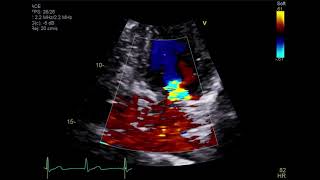 Transthoracic echocardiogram showing four chamber focused view with color doppler [upl. by Slorac]