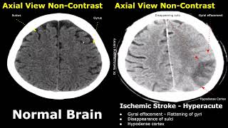 CT Scan Brain Normal Vs Ischemic Stroke Images  NonContrast HyperacuteAcuteChronic Infarction [upl. by Tasha800]