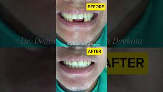 Replacing missing front teethRemovable partial dentureDr Swostik Devkota Esthetic Transformation [upl. by Llewkcor]