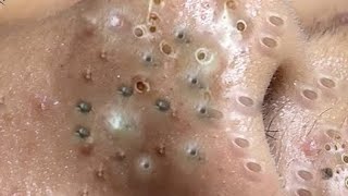 Amazing Blackhead remover remove blackheads blackheads [upl. by Aita51]