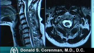 How to Read a MRI of Cervical Stenosis with Spinal Cord Injury  Spine Surgeon in Colorado [upl. by Monti]