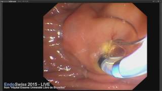 EndoSwiss 2015 LIVE case ERCP wih biliary sphincterotomy and stenting for palliative purpose [upl. by Koral]