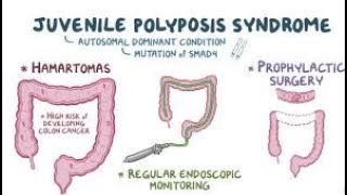 Juvenile Polyposis Syndrome [upl. by Aikaz61]