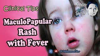 MaculoPapular Rash with Fever  Ocean Derma  Clinical Tips [upl. by Nwahsav]