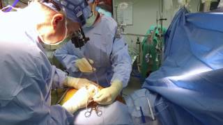 Minimally Invasive Bypass A Better Way Sanger Heart amp Vascular Institute [upl. by Adnael]