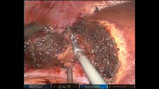 Simultaneous Robotic Right Colectomy with Intracorporeal Anastomosis and Partial Hepatectomy [upl. by Ainaznat305]