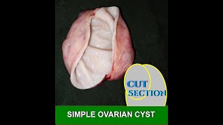 SIMPLE OVARIAN CYST [upl. by Sheree]