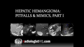 Hepatic Hemangioma Pitfalls amp Mimics Part I [upl. by Assel576]