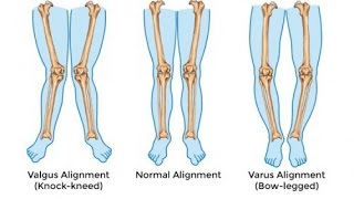 How to correct bow legs without surgery [upl. by Elolcin4]