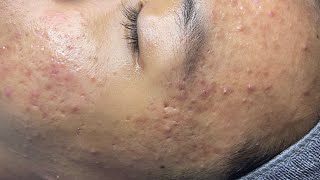 ACNE TREATMENT VU QUYNH MI Acne On Teens Nose 2024 [upl. by Souvaine]