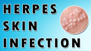 Herpes Simplex Virus Symptoms and Treatment [upl. by Nerradal557]